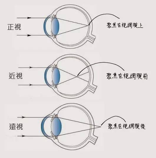 近视早知道:你家孩子"远视储备"还剩多少?